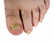 Fungal Infection of the toenail