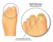 Also know as toe rot, this is a nail fungal infection