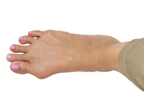 Successfully treating Bunions with custom splints